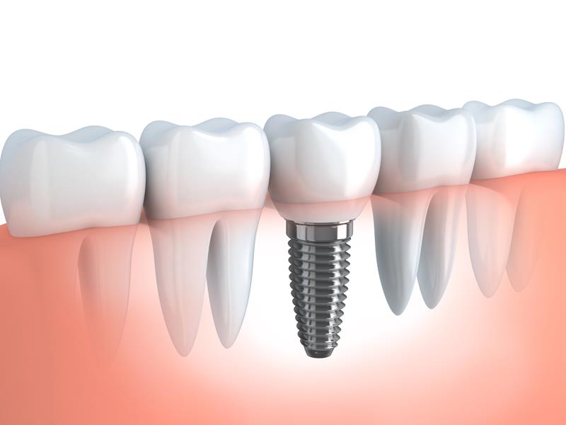 Dental Implants  Clinton Township, MI 